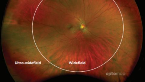 Ultra-widefield